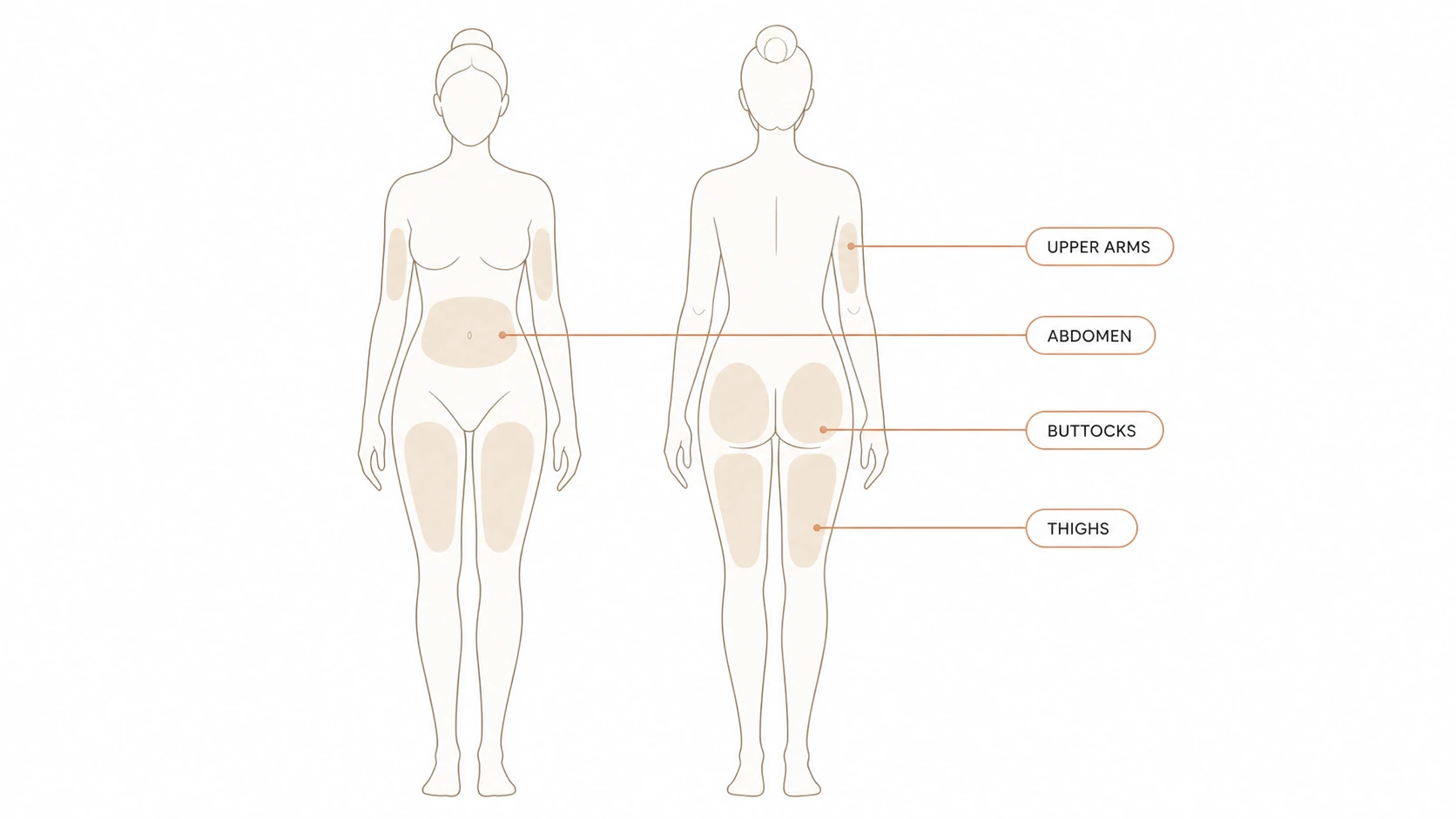 Front and back body map highlighting the upper arms, abdomen, buttocks and thighs