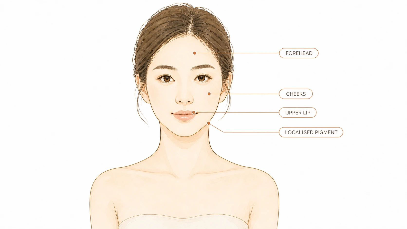 Face illustration marking the forehead, cheeks and upper lip, where melasma patches usually appear