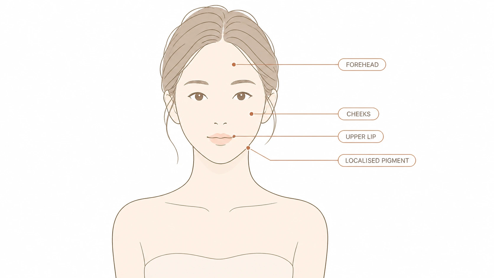Line drawing of a face marking the forehead, cheeks and upper lip