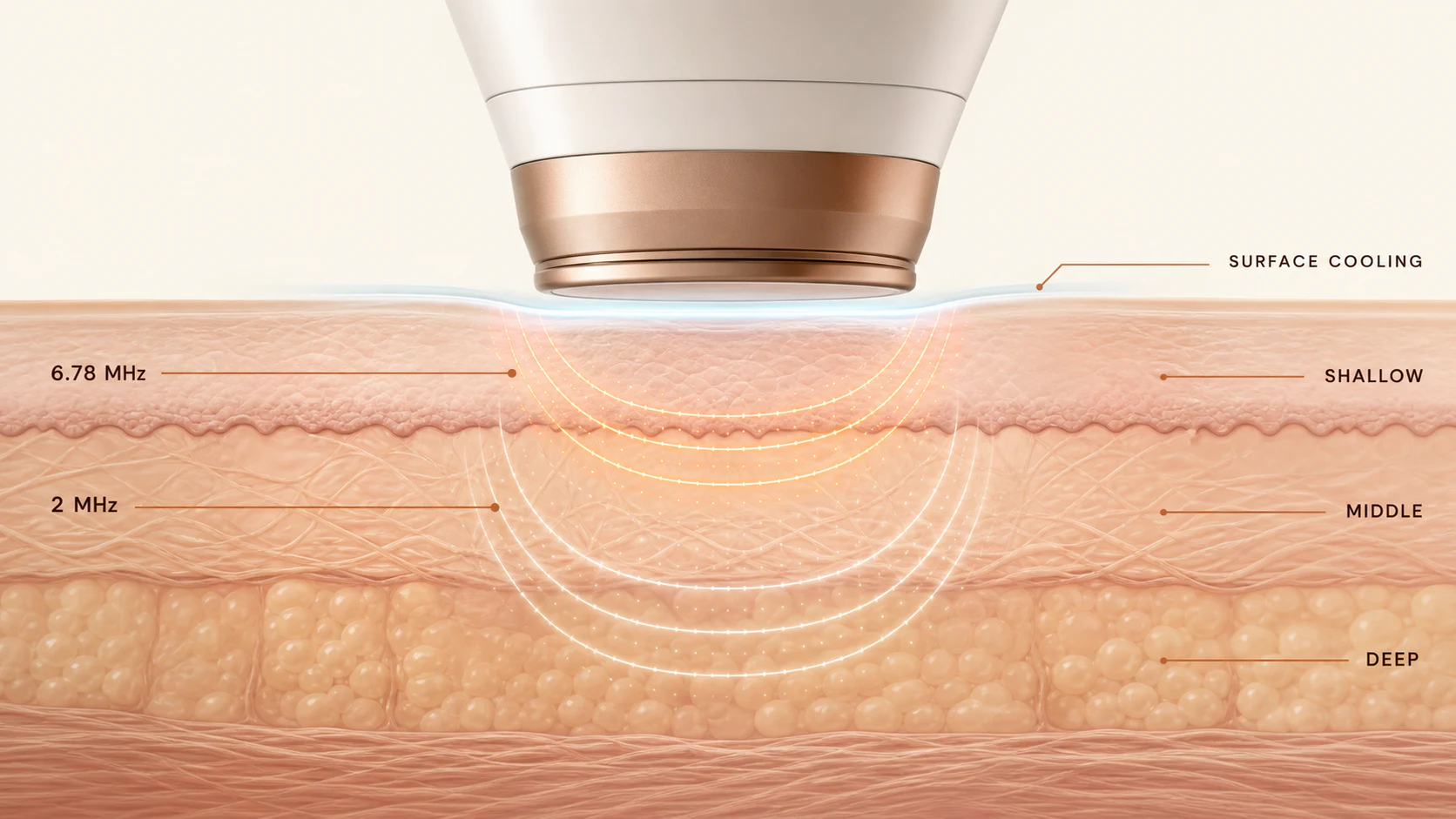 Diagram of 6.78 MHz and 2 MHz radiofrequency energy reaching shallow, middle and deep skin layers under a cooled surface