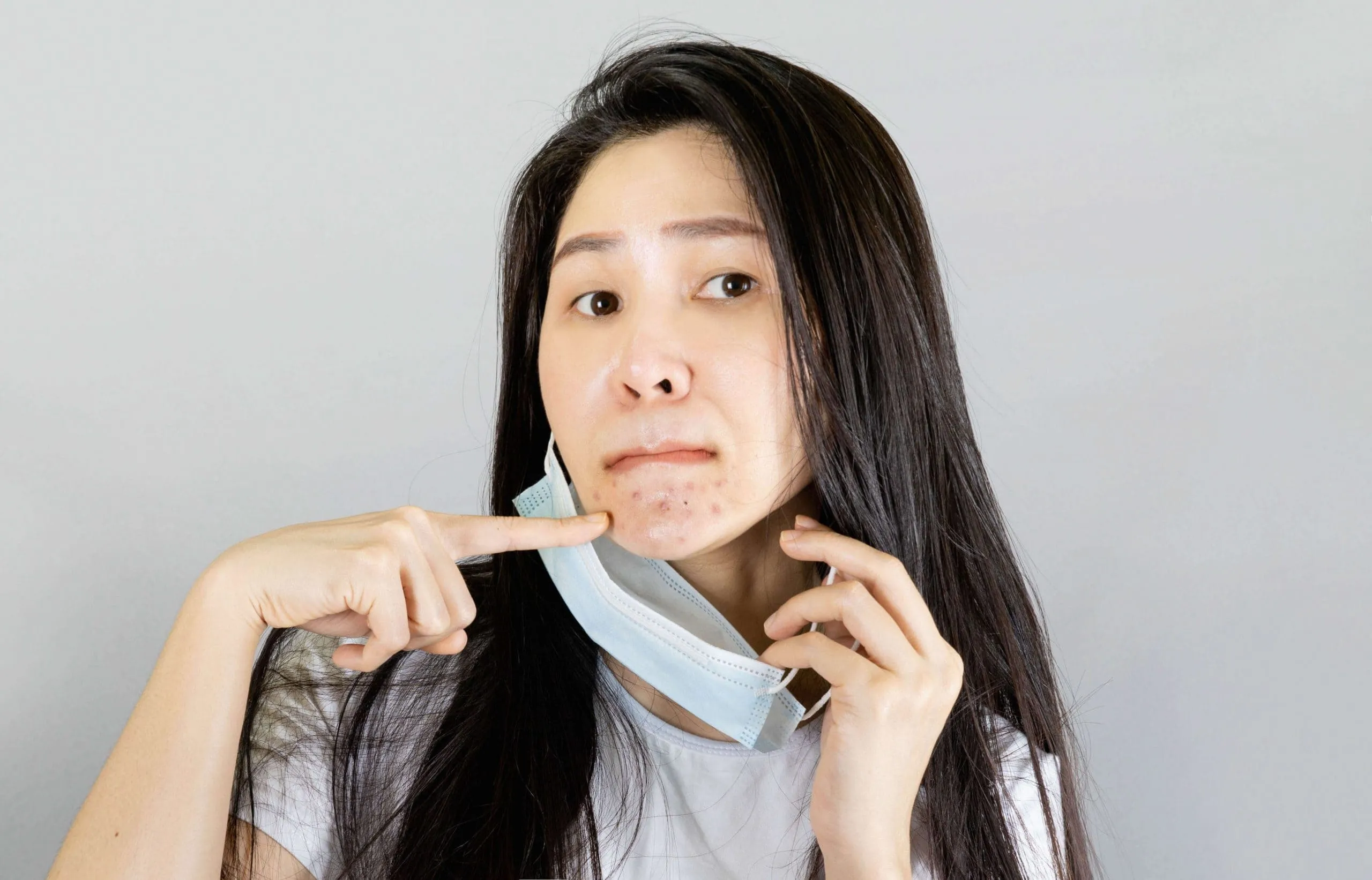 Woman pointing to acne on her chin