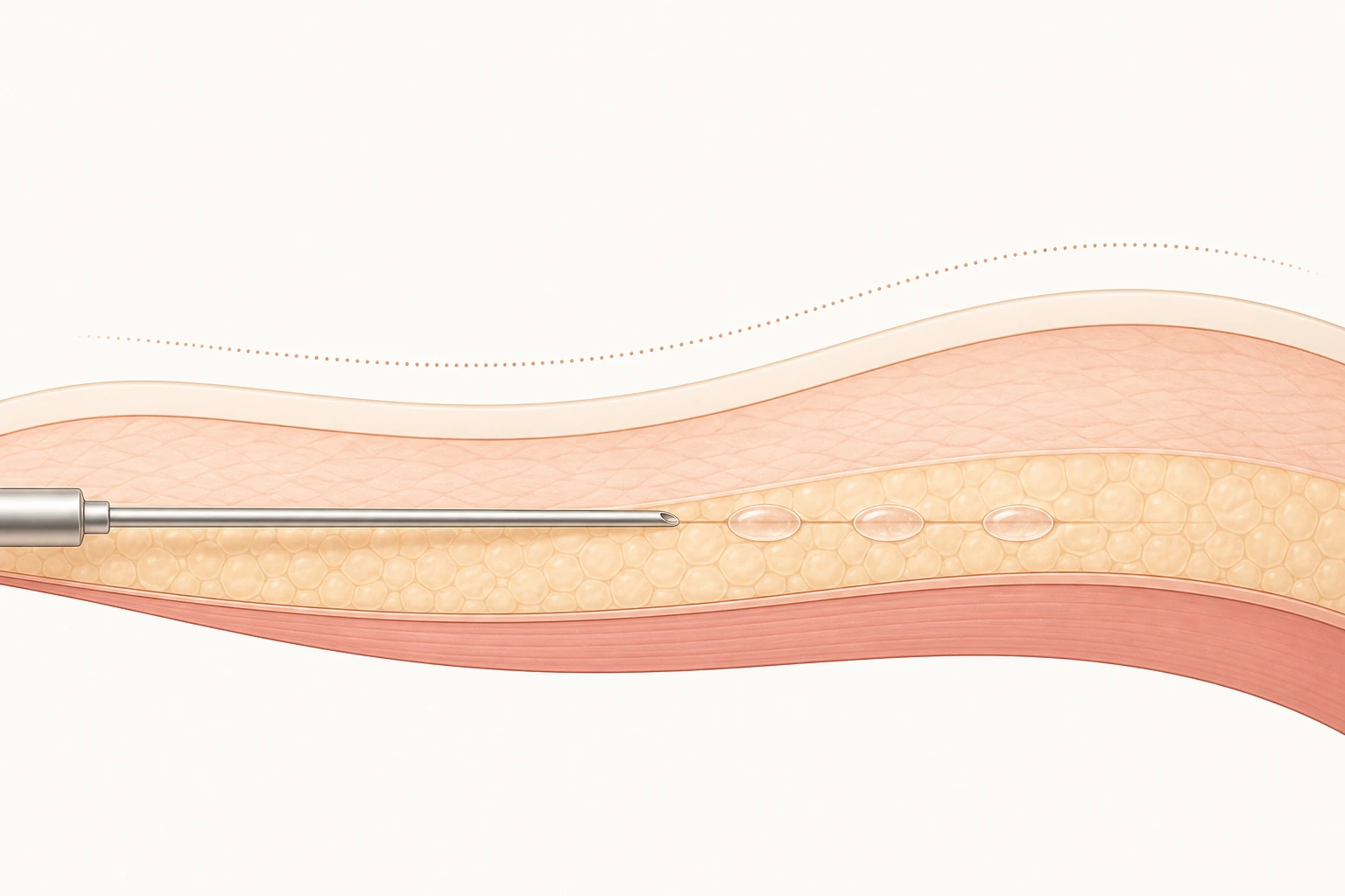 Skin cross-section illustrating an injectable treatment